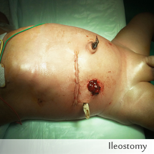 Ileostomy