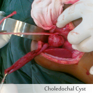 Choledochal cyst