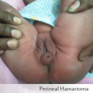 Perineal Hamartoma