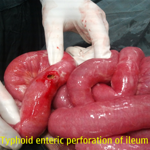 Typhoid Enteric Perforation of Ileum