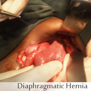 Diaphragmatic Hernia